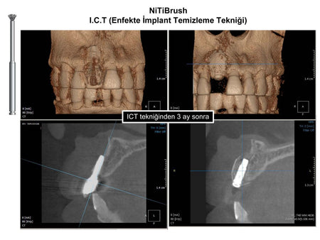 Dentkonsept - Niti Brush OMEGA Periimplantitis Bur