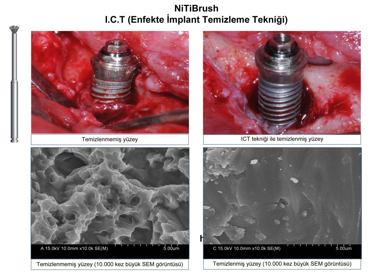 Dentkonsept - Niti Brush OMEGA Periimplantitis Bur