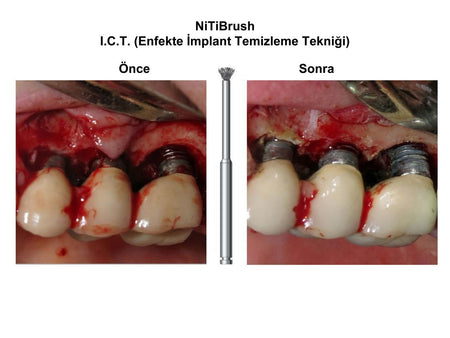 Dentkonsept - Nitibrush Peri - Implantitis Bur Set - 2 pcs