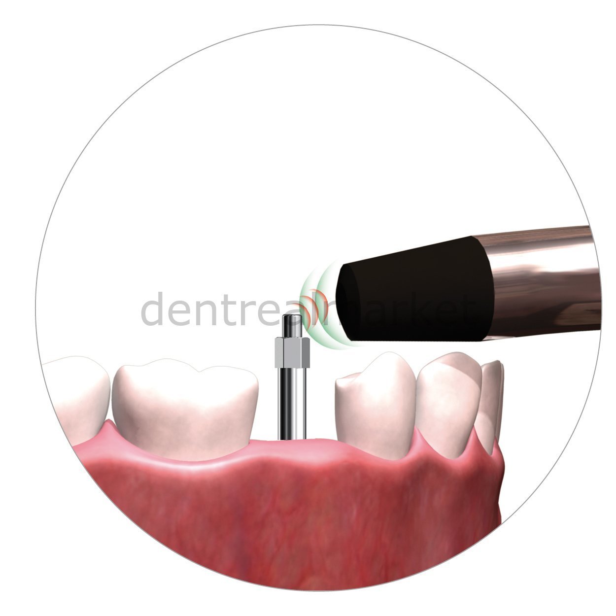 W&H Dental - Osstell Smartpegs Osstell Bits