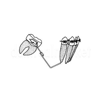 Molar Uprighting Springs